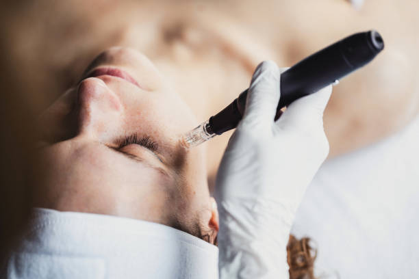 Microneedling